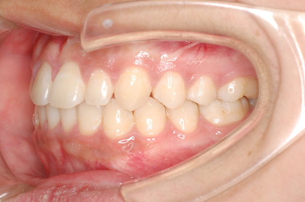 交叉咬合 愛知県豊田市の矯正歯科専門 三宅矯正歯科クリニック