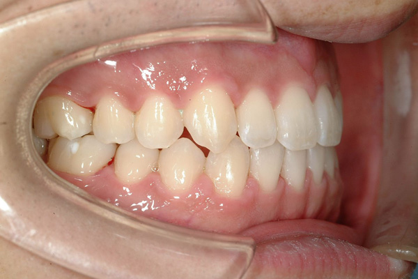 交叉咬合 愛知県豊田市の矯正歯科専門 三宅矯正歯科クリニック