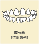 隙っ歯（空隙歯列）